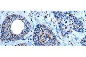 Immunohistochemistry of paraffin-embedded Human cervical cancer tissue using WISP2 Polyclonal Antibody at dilution of 1:45(x200)