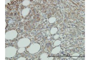 Immunoperoxidase of monoclonal antibody to PROCR on formalin-fixed paraffin-embedded human malignant lymphoma, diffuse large B tissue. (PROCR Antikörper  (AA 1-238))