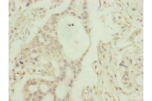 Immunohistochemistry of paraffin-embedded human pancreatic cancer using ABIN7148371 at dilution of 1:100