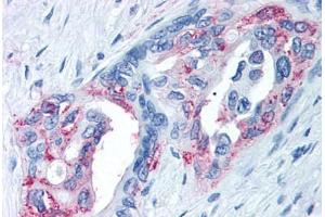 Anti-TRPM8 antibody  ABIN1049436 IHC staining of human prostate carcinoma. (TRPM8 Antikörper  (Internal Region))