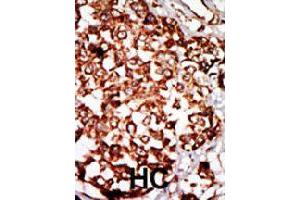 Formalin-fixed and paraffin-embedded human hepatocellular carcinoma tissue reacted with NRBP1 polyclonal antibody  , which was peroxidase-conjugated to the secondary antibody, followed by DAB staining. (NRBP1 Antikörper  (N-Term))