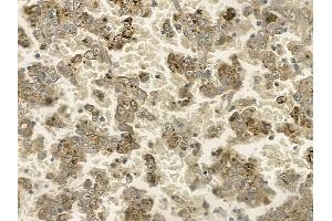 ABIN6255351 and ABIN6267196 at 1/100 staining human renal cell carcinoma by IHC-P. (TPT1 Antikörper  (pSer46))