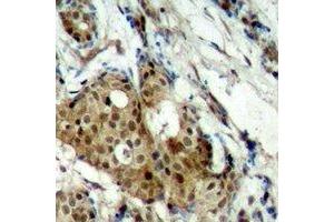 Immunohistochemical analysis of CDK11B staining in human breast cancer formalin fixed paraffin embedded tissue section. (CDK11 Antikörper  (N-Term))