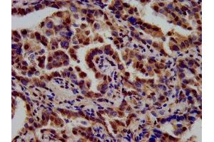 IHC image of ABIN7171895 diluted at 1:700 and staining in paraffin-embedded human lung cancer performed on a Leica BondTM system. (Tetraspanin 9 Antikörper  (AA 107-203))