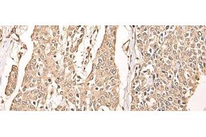 Immunohistochemistry of paraffin-embedded Human prost ate cancer tissue using ATAD3A Polyclonal Antibody at dilution of 1:40(x200) (ATAD3A Antikörper)