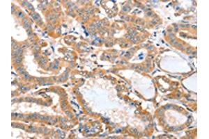 The image on the left is immunohistochemistry of paraffin-embedded Human thyroid cancer tissue using ABIN7128162(ACOT11 Antibody) at dilution 1/25, on the right is treated with fusion protein. (ACOT11 Antikörper)