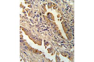 Formalin-fixed and paraffin-embedded human lung carcinoma reacted with IL8 Antibody (C-term), which was peroxidase-conjugated to the secondary antibody, followed by DAB staining.