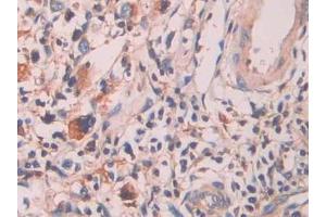 Detection of SAP in Human Stomach cancer Tissue using Polyclonal Antibody to Serum Amyloid P Component (SAP) (APCS Antikörper  (AA 23-223))