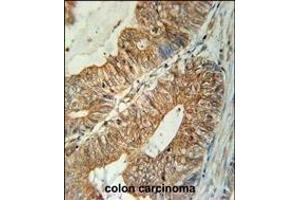 TSN3 Antibody (Center) (ABIN651749 and ABIN2840386) immunohistochemistry analysis in formalin fixed and raffin embedded human colon carcinoma followed by peroxidase conjugation of the secondary antibody and DAB staining. (Tetraspanin 3 Antikörper  (AA 90-117))