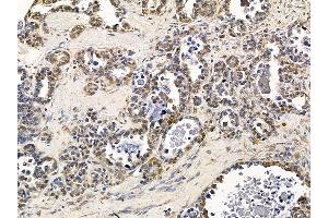 ABIN7094219 and ABIN7098265 at 1/100 staining human ovarian cancer by IHC-P.