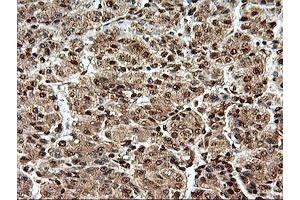 Immunohistochemical staining of paraffin-embedded Carcinoma of Human liver tissue using anti-SAMHD1 mouse monoclonal antibody. (SAMHD1 Antikörper)