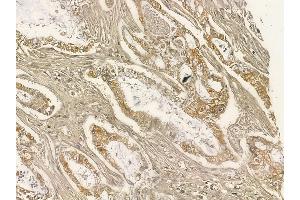 ZFYVE1 Mouse Monoclonal Antibody at 1/100 staining human pancreatic cancer and adjacent non-tumor tissue by IHC-P. (ZFYVE1 Antikörper)
