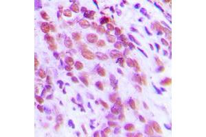 Immunohistochemical analysis of NF-kappaB p65 (pS276) staining in human breast cancer formalin fixed paraffin embedded tissue section.