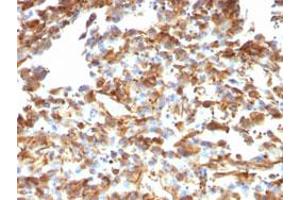 Immunohistochemical staining (Formalin-fixed paraffin-embedded sections) of human melanoma with VIM monoclonal antibody, clone VM1170 . (Vimentin Antikörper)