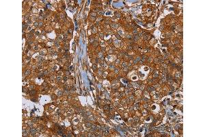 Immunohistochemistry of Human breast cancer using PLEC Polyclonal Antibody at dilution of 1:40