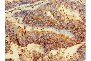 Immunohistochemistry of paraffin-embedded human endometrial cancer using ABIN7153928 at dilution of 1:100 (GPI Antikörper  (AA 2-554))