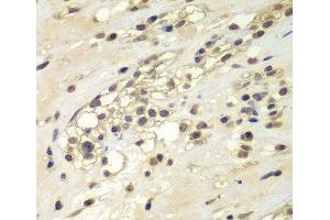 Immunohistochemistry of paraffin-embedded Human kidney cancer using CHEK1 Polyclonal Antibody at dilution of 1:100 (40x lens). (CHEK1 Antikörper)