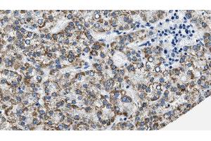 ABIN6275941 at 1/100 staining Human liver cancer tissue by IHC-P. (PTGER3 Antikörper  (C-Term))