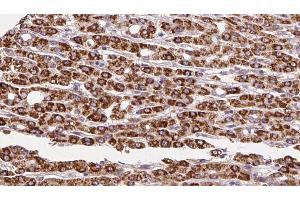 ABIN6272254 at 1/100 staining Human liver cancer tissue by IHC-P. (ADRB3 Antikörper  (Internal Region))
