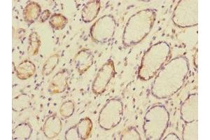 Immunohistochemistry of paraffin-embedded human colon cancer using ABIN7146794 at dilution of 1:100 (CEACAM4 Antikörper  (AA 36-155))