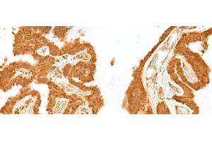 Immunohistochemistry of paraffin-embedded Human thyroid cancer tissue using GANC Polyclonal Antibody at dilution of 1:55(x200) (GANC Antikörper)