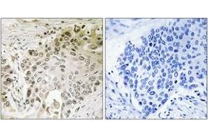 Immunohistochemistry analysis of paraffin-embedded human lung carcinoma, using RFX2 Antibody.