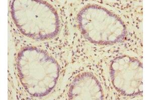 Immunohistochemistry of paraffin-embedded human colon cancer using ABIN7159601 at dilution of 1:100 (MSRB2 Antikörper  (AA 10-182))
