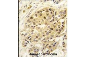 Formalin-fixed and paraffin-embedded human breast carcinoma tissue reacted with SENP3 antibody (N-term) (ABIN388047 and ABIN2845593) , which was peroxidase-conjugated to the secondary antibody, followed by DAB staining. (SENP3 Antikörper  (N-Term))