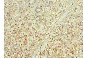 Immunohistochemistry of paraffin-embedded human pancreatic cancer using ABIN7146098 at dilution of 1:100 (MRC2 Antikörper  (AA 120-300))