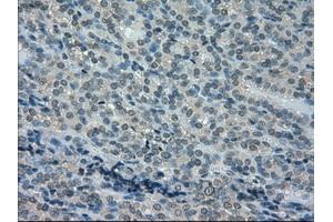 Immunohistochemical staining of paraffin-embedded Carcinoma of kidney tissue using anti-DHFRmouse monoclonal antibody. (Dihydrofolate Reductase Antikörper)
