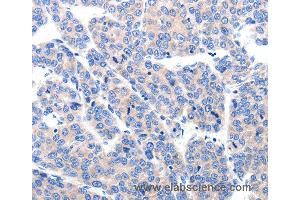 Immunohistochemistry of Human liver cancer using KCNH8 Polyclonal Antibody at dilution of 1:50 (KCNH8 Antikörper)