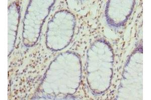Immunohistochemistry of paraffin-embedded human colon cancer using ABIN7149288 at dilution of 1:100 (Cytohesin 2 Antikörper  (AA 150-350))
