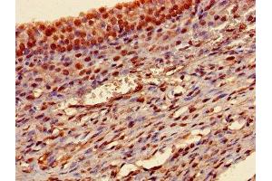 Immunohistochemistry of paraffin-embedded human ovarian cancer using ABIN7172847 at dilution of 1:100 (Transgelin Antikörper  (AA 2-201))