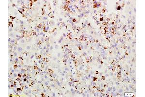 Formalin-fixed and paraffin embedded mouse melanoma labeled with Rabbit Anti ABCB5 Polyclonal Antibody, Unconjugated (ABIN731933) at 1:200 followed by conjugation to the secondary antibody and DAB staining (ABCB5 Antikörper  (AA 841-883))