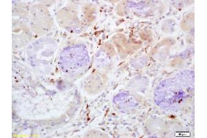 Formalin-fixed and paraffin embedded human lung carcinoma with labeled Anti-Properdin Polyclonal Antibody, Unconjugated (ABIN1386799) at 1:200, followed by conjugation to the secondary antibody and DAB staining (CFP Antikörper  (AA 401-469))