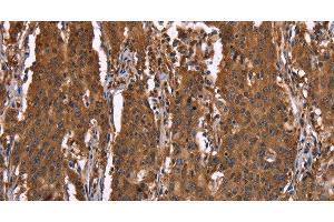Immunohistochemistry of paraffin-embedded Human gastic cancer using HINT1 Polyclonal Antibody at dilution of 1:30 (HINT1 Antikörper)