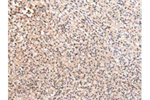 The image on the left is immunohistochemistry of paraffin-embedded Human prostate cancer tissue using ABIN7192170(RERE Antibody) at dilution 1/20, on the right is treated with synthetic peptide. (RERE Antikörper)