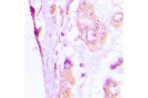 Immunohistochemical analysis of CAP18 staining in human lung cancer formalin fixed paraffin embedded tissue section. (Cathelicidin Antikörper)