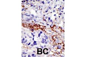 Formalin-fixed and paraffin-embedded human breast cancer tissue reacted with USP21 polyclonal antibody  , which was peroxidase-conjugated to the secondary antibody, followed by DAB staining. (USP21 Antikörper  (AA 406-436))