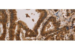 Immunohistochemistry of paraffin-embedded Human colon cancer tissue using CSNK2B Polyclonal Antibody at dilution of 1:30(x200) (CSNK2B Antikörper)