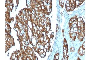 Formalin-fixed, paraffin-embedded human Colon Carcinoma stained with TACSTD2 / TROP2 Mouse Monoclonal Antibody (TACSTD2/2151).