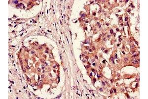 Immunohistochemistry of paraffin-embedded human breast cancer using ABIN7164982 at dilution of 1:100 (PSMB5 Antikörper  (AA 106-188))