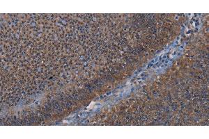 Immunohistochemistry of paraffin-embedded Human rectal cancer using P3H3 Polyclonal Antibody at dilution of 1:50