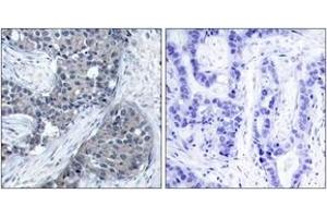 Immunohistochemistry analysis of paraffin-embedded human breast carcinoma, using eIF4E (Phospho-Ser209) Antibody. (EIF4E Antikörper  (pSer209))