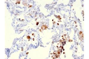 Formalin-fixed, paraffin-embedded human Lung Adenocarcinoma stained with Napsin A Mouse Monoclonal Antibody (NAPSA/3306). (NAPSA Antikörper  (AA 189-299))
