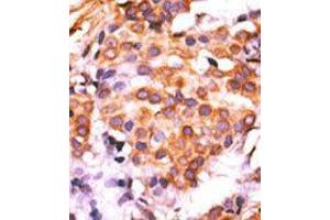 Formalin-fixed and paraffin-embedded human cancer tissue reacted with the primary antibody, which was peroxidase-conjugated to the secondary antibody, followed by AEC staining.