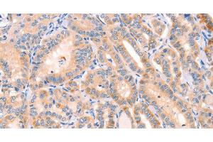 Immunohistochemistry of paraffin-embedded Human thyroid cancer tissue using CD109 Polyclonal Antibody at dilution 1:30 (CD109 Antikörper)