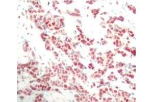 Immunohistochemistry of paraffin-embedded Human breast carcinoma using Phospho-NFkB p100(S866) Polyclonal Antibody (NFKB2 Antikörper  (pSer866))