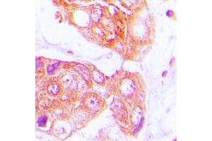 Immunohistochemical analysis of HSP40 staining in human lung cancer formalin fixed paraffin embedded tissue section. (DNAJB1 Antikörper  (C-Term))