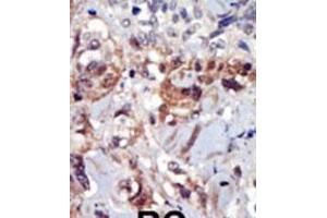 Formalin-fixed and paraffin-embedded human cancer tissue reacted with the primary antibody, which was peroxidase-conjugated to the secondary antibody, followed by AEC staining. (PIP4K2A Antikörper  (C-Term))